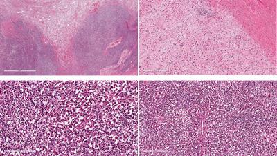 An integrative morpho-molecular approach in malignant ectomesenchymoma diagnosis: report of a new paediatric case and a review of the literature